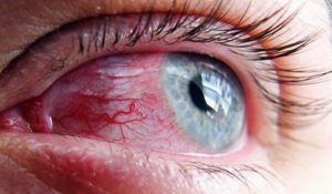 Красные глаза разрыв капилляров 