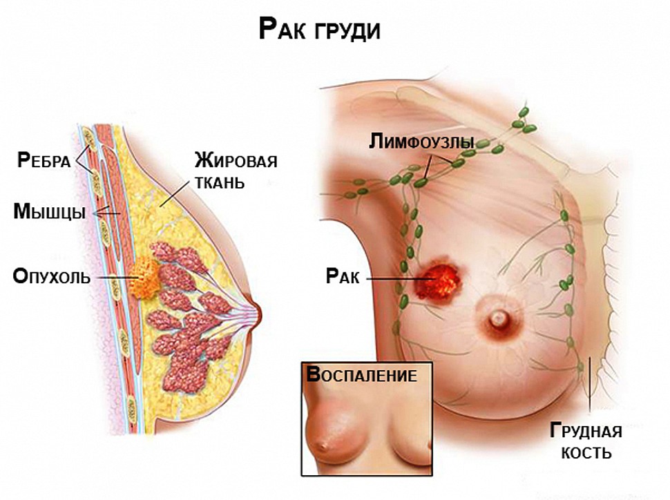 Профилактика рака молочной железы