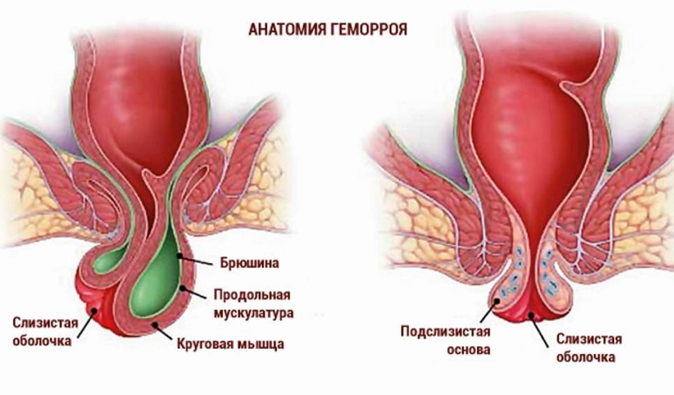 Геморрой часто не лечат, что приводит к осложнениям