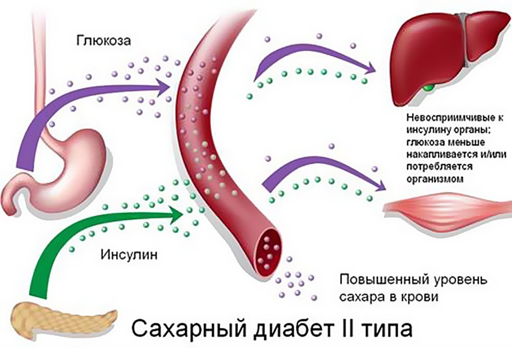 Тип сахарного диабета номер два связан с весом