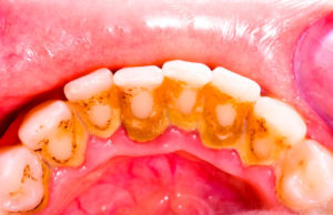 Симптомы зубного камня 